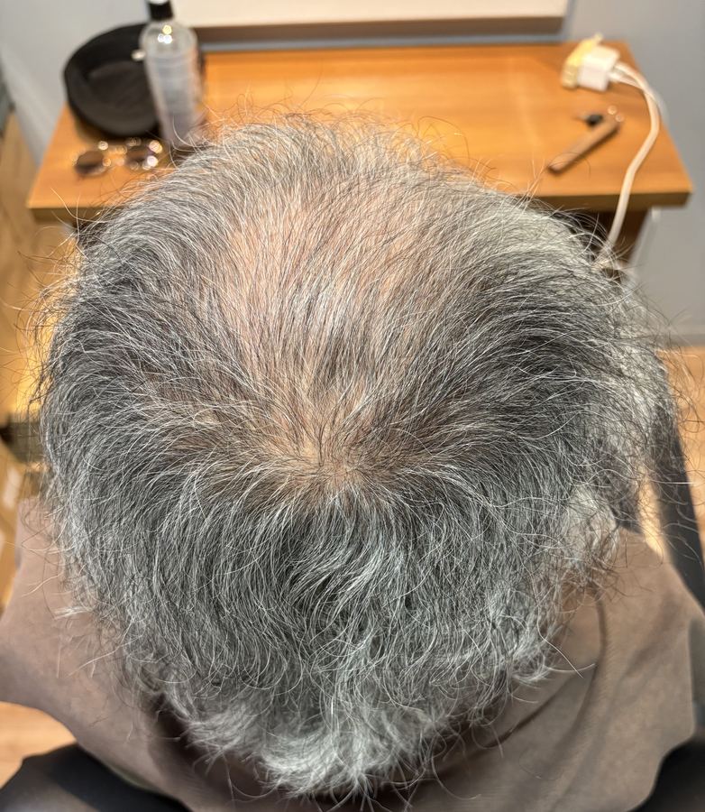 【衝撃】ヘアセットだけでここまで変わる！薄毛コンプレックス解消メソッド