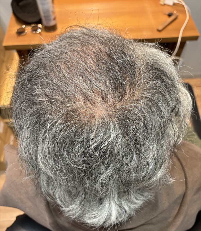 【衝撃】ヘアセットだけでここまで変わる！薄毛コンプレックス解消メソッド