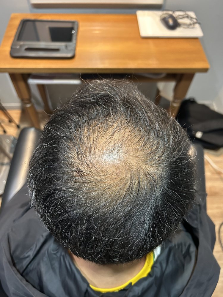 50代男性・約1ヶ月半後の頭頂部
