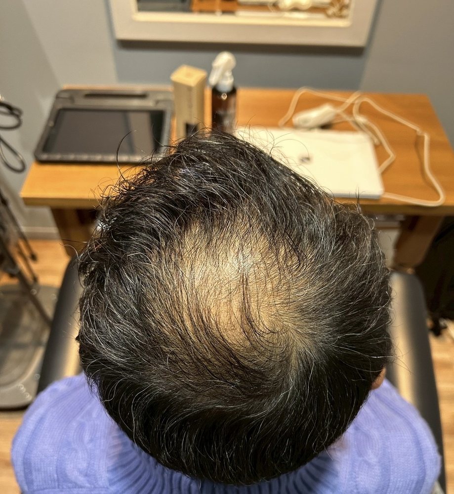 50代男性・約2ヶ月半後の頭頂部(別角度)
