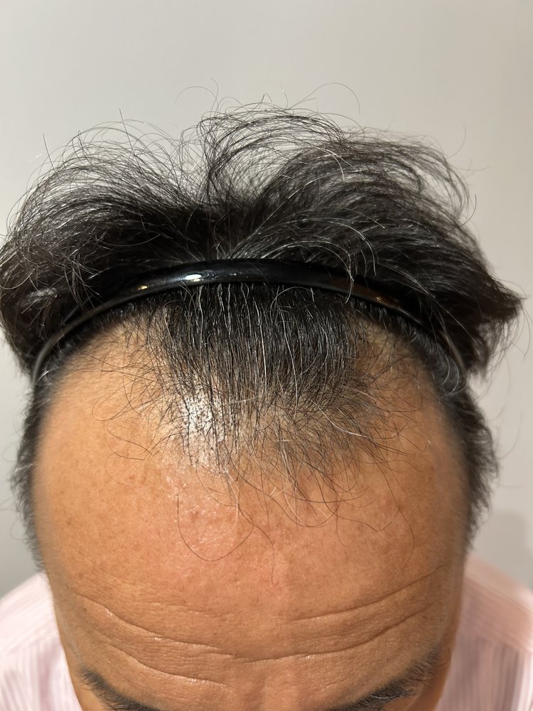 50代男性・開始時の前頭部の生え際