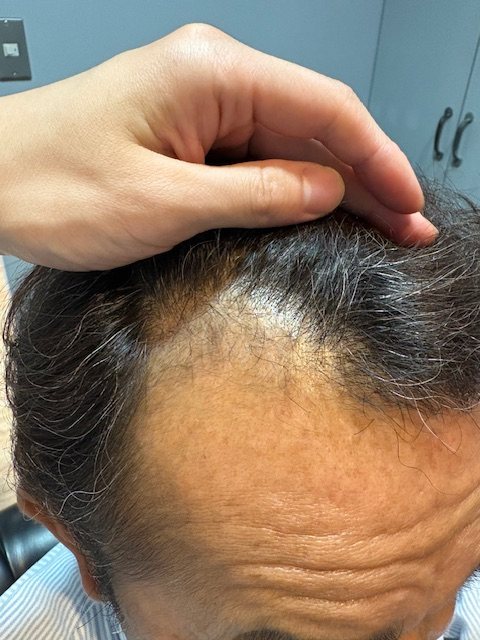 50代男性・約1年半後の生え際・分け目