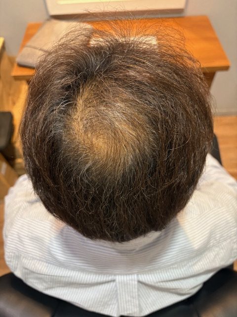50代男性・約1年半後の頭頂部