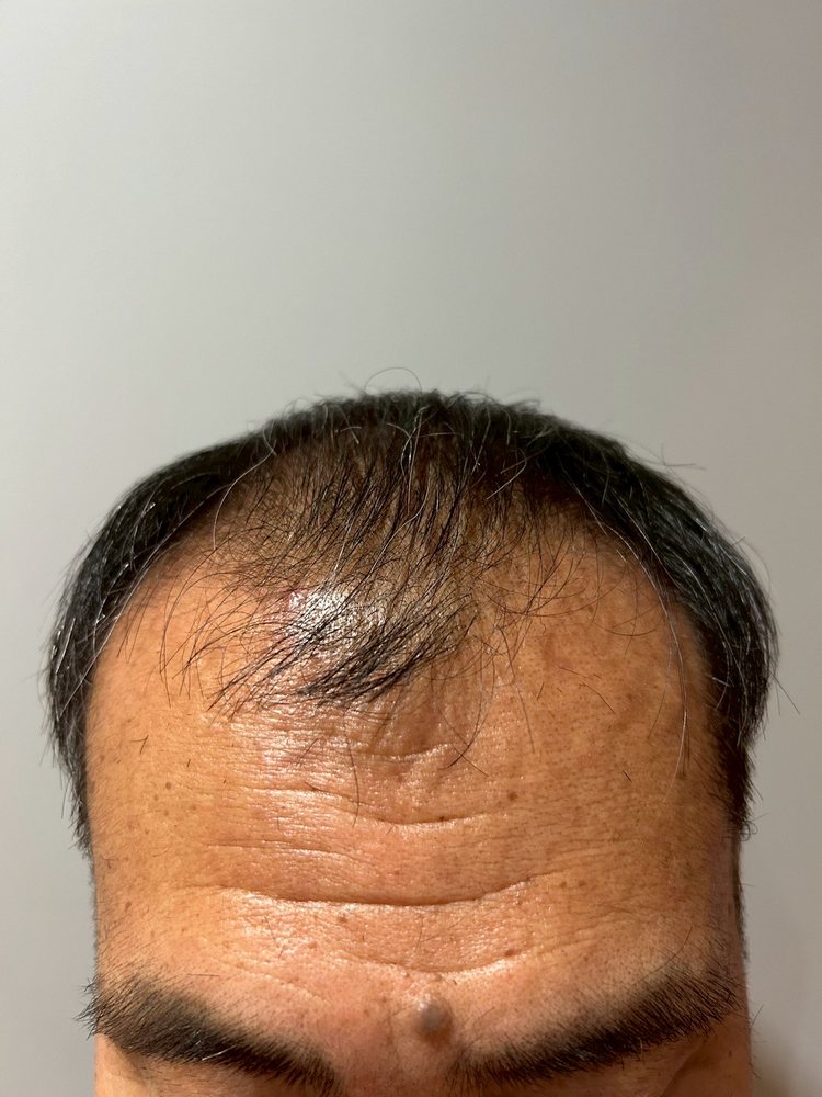 60代男性・開始時の生え際(M字部分)
