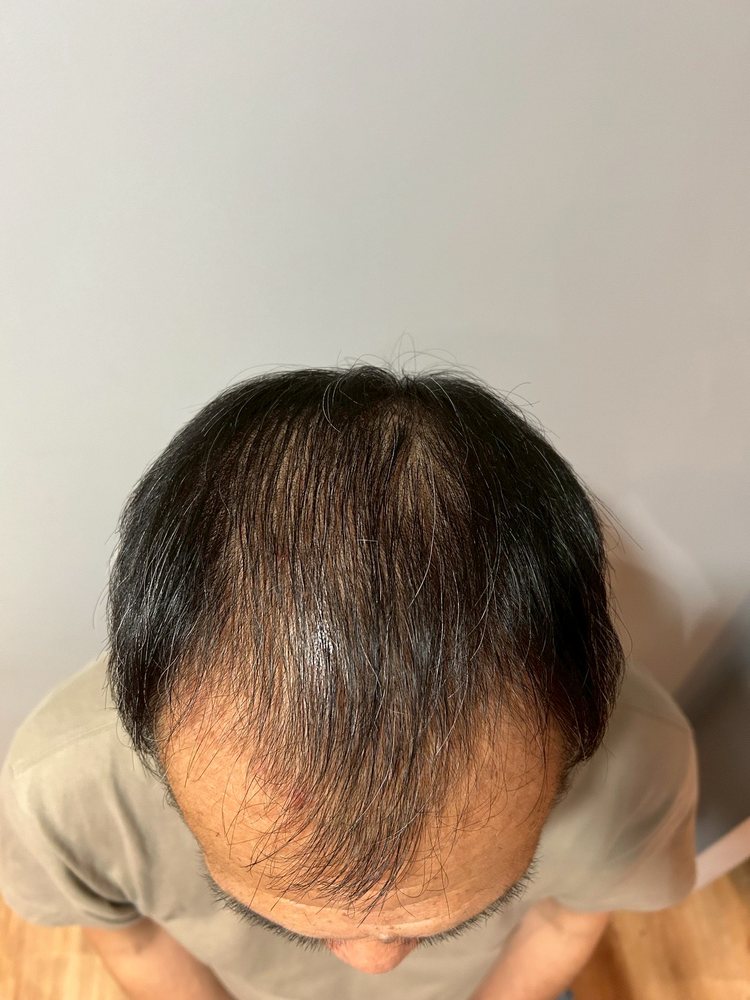 60代男性・開始時の頭頂部