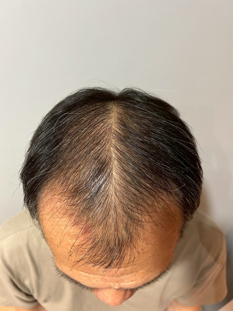 60代男性・開始時の頭頂部から後頭部